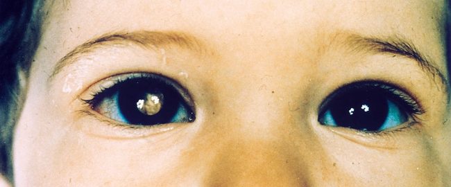 Złoty odblask w oku dziecka. Reakcja powinna być natychmiastowa